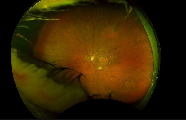 Der Augenhintergrund eines Patienten mit geografischer Atrophie, einem fortgeschrittenen Stadium der altersbedingten Makuladegeneration (AMD). Foto: UKSH