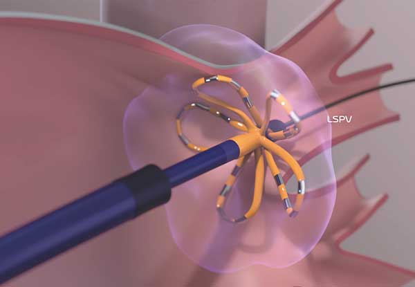 Mit der Pulsfeld-Ablations-Technologie können durch kurze elektrische Impulse Herzmuskelzellen verödet werden, die den Herzschlag aus dem Takt bringen.
Foto: Farapulse