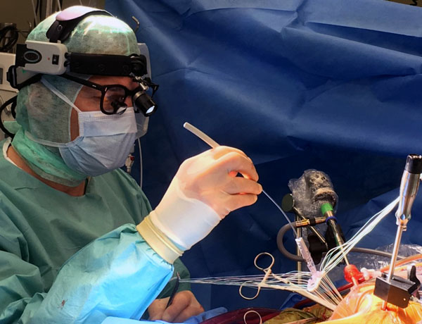 Eine minimalinvasive Mitralklappenreparatur durch Prof. Dr. Stephan Ensminger, Direktor der Klinik für Herz- und thorakale Gefäßchirurgie. Foto: UKSH